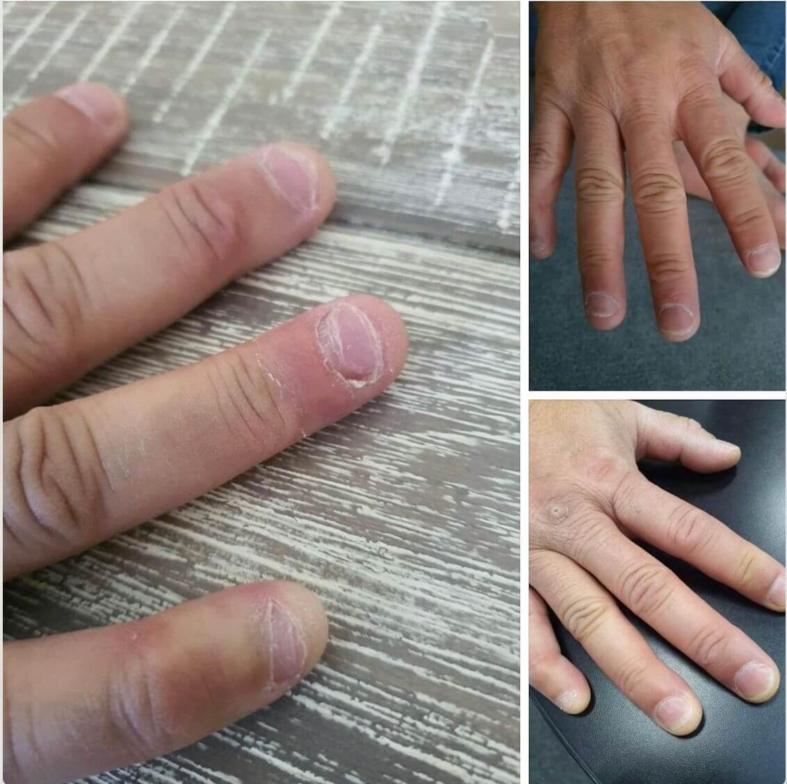 Perbandingan kulit kering di sekitar kuku sebelum dan setelah 2 minggu menggunakan Herbal Body Oil L'Âme de Bali