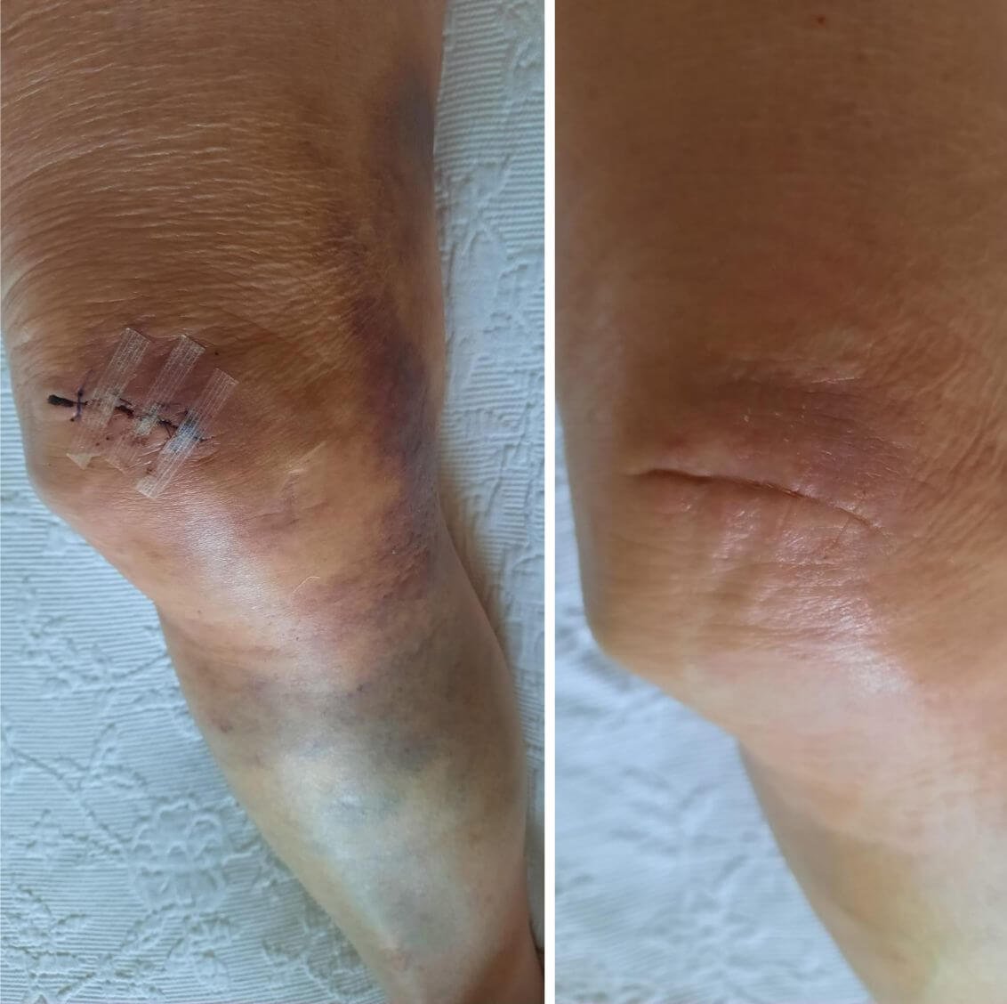 Dokumentasi sebelum dan setelah perawatan kulit kaki setelah luka dengan ritual L'Âme de Bali